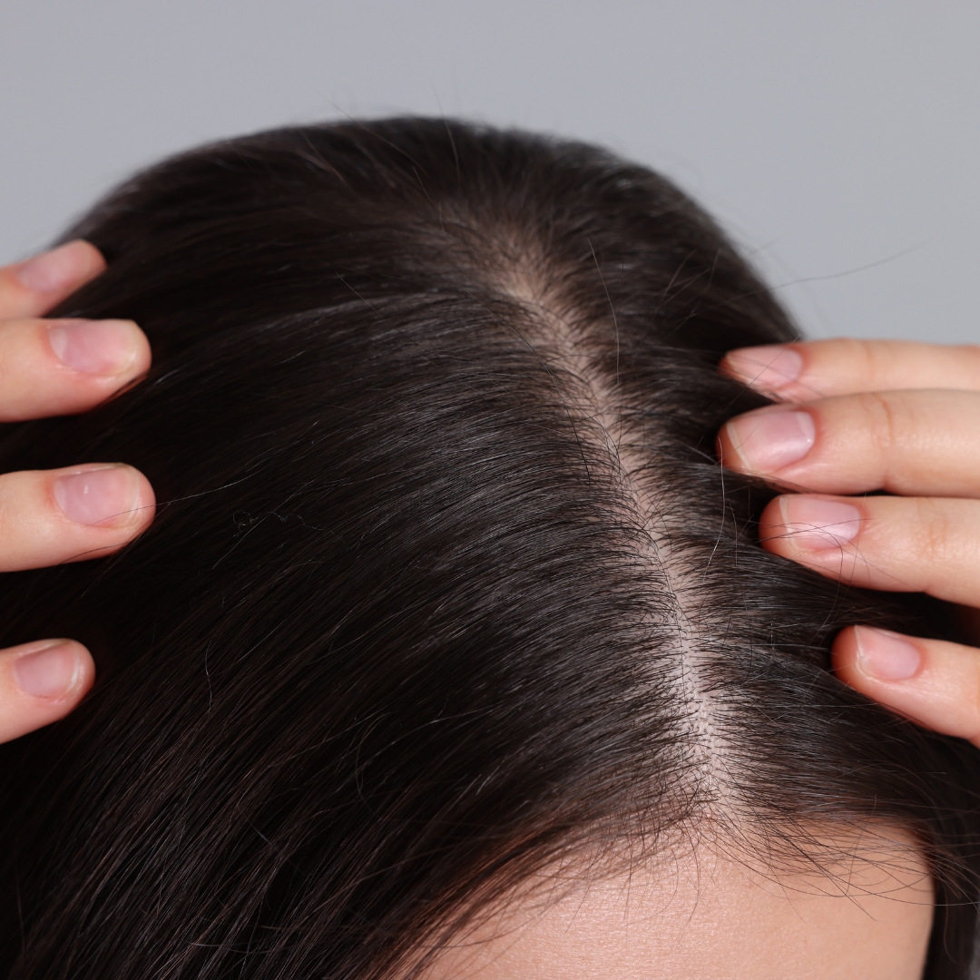 Scalp micropigmentation result Dubai