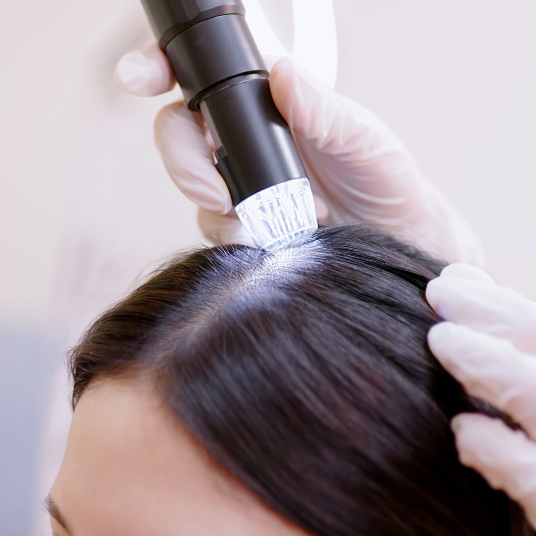 Scalp micropigmentation at Snatch & Glow Dubai